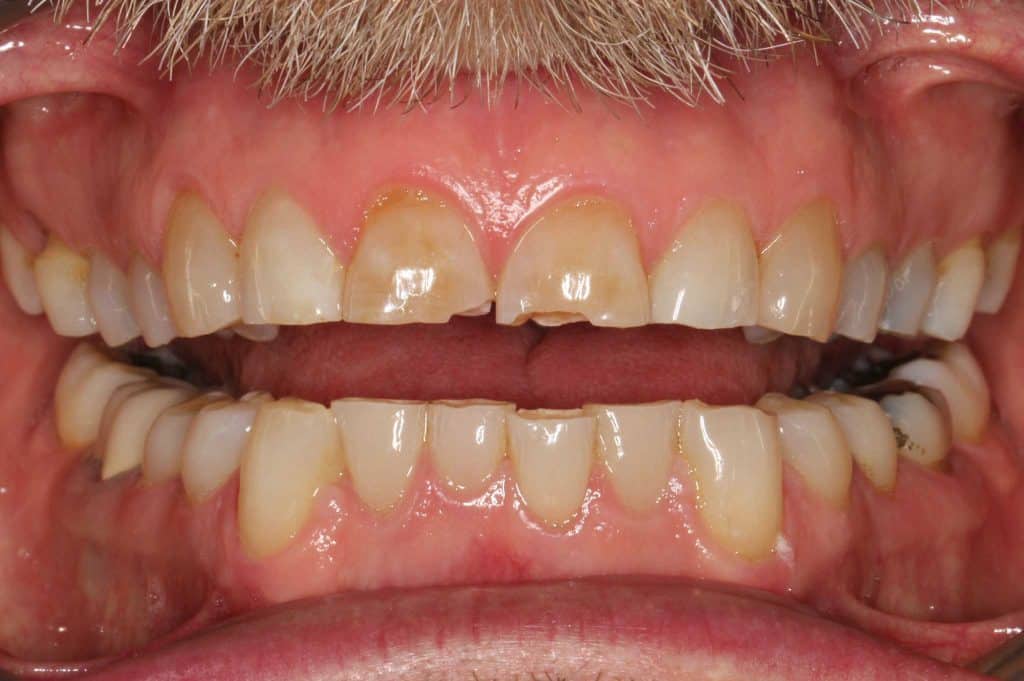 Ved Kolbotn Tannklinikk vises hvordan slitasjeskader og gnissing kan gi ising i tennene – Kolbotn, Follo, Sofiemyr og Holmlia.