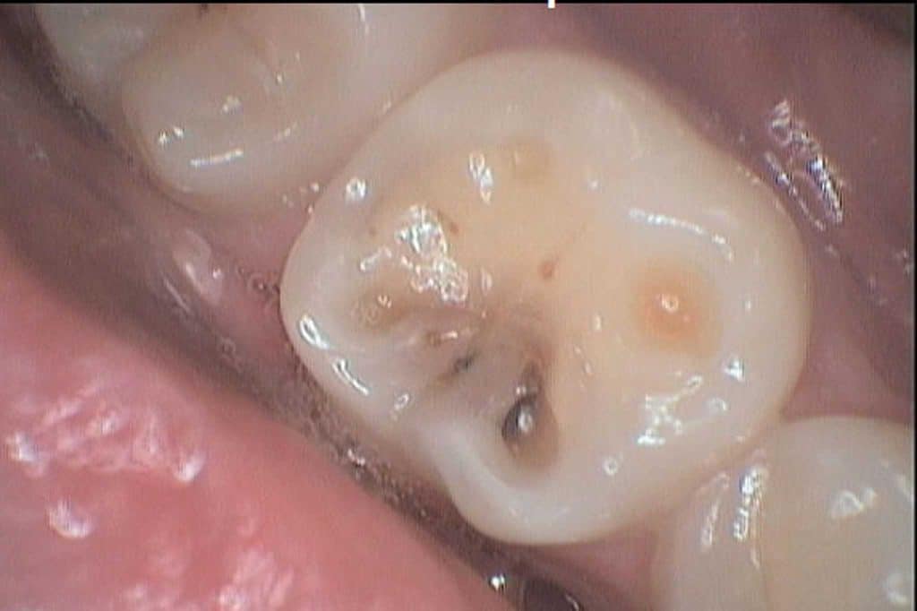 Hos Kolbotn Tannklinikk illustreres hvordan karies kan føre til ising i tennene – Kolbotn, Follo, Nordstrand og Myrvoll.