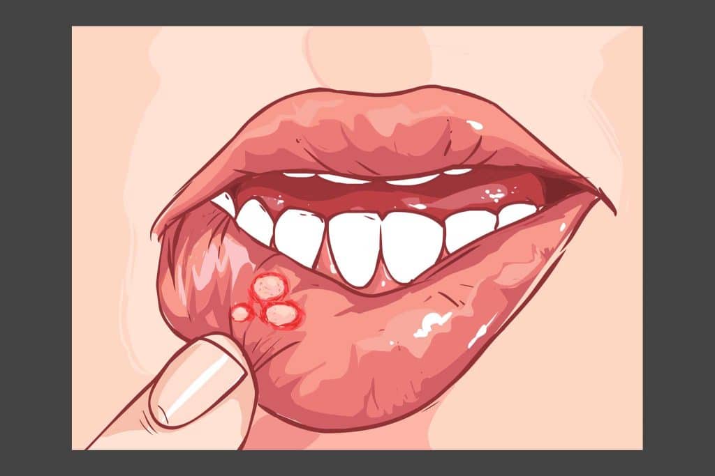 Hos Kolbotn Tannklinikk illustreres munnskold (after) med sår på innsiden av leppen – Kolbotn, Follo, Oppegård og Nordstrand.