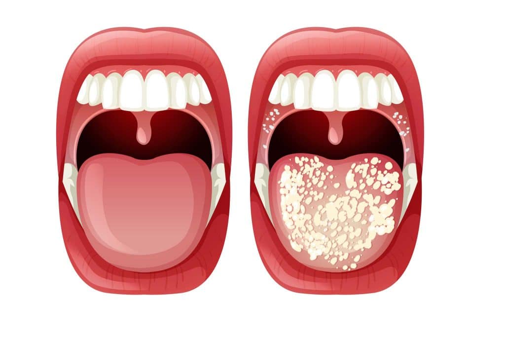 Hos Kolbotn Tannklinikk vises forskjellen på en frisk munnhule og en infisert med candida – Kolbotn, Follo, Oppegård og Nordstrand.