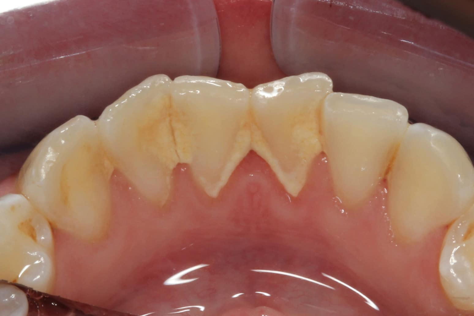 Hos Kolbotn Tannklinikk fjernes tannstein for å styrke tannkjøttet og bevare tennene – synlig forbedring i Kolbotn, Vinterbro og Holmlia.