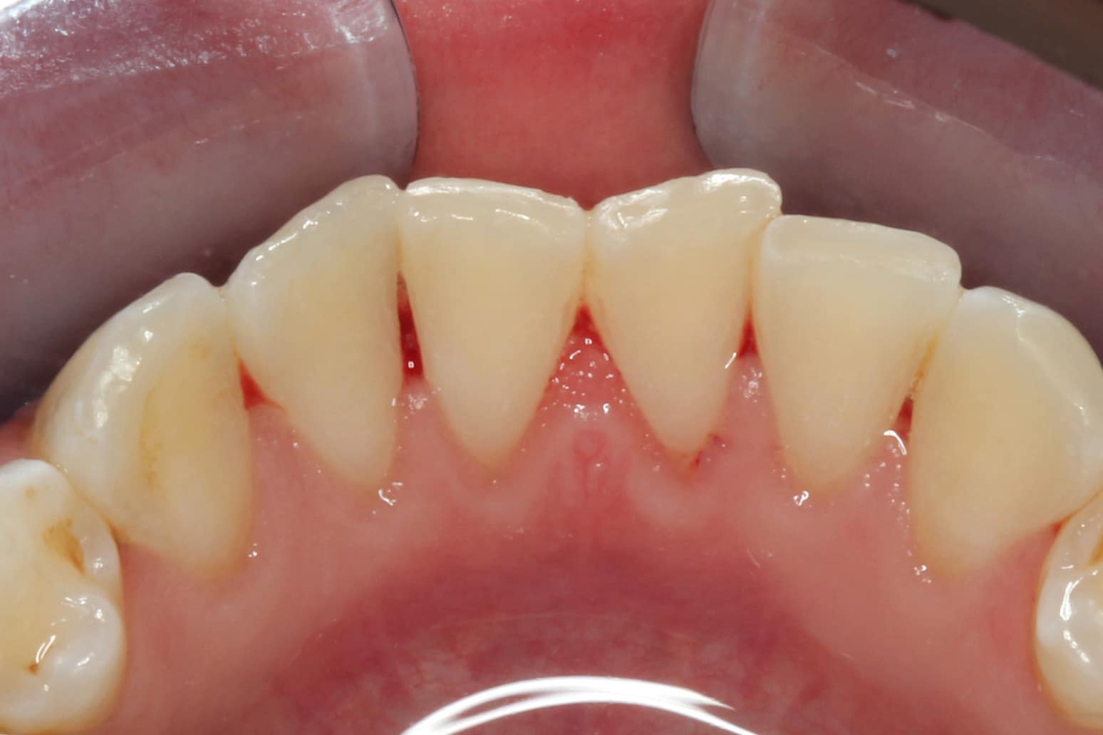 Før- og etterbilde av tannsteinfjerning.