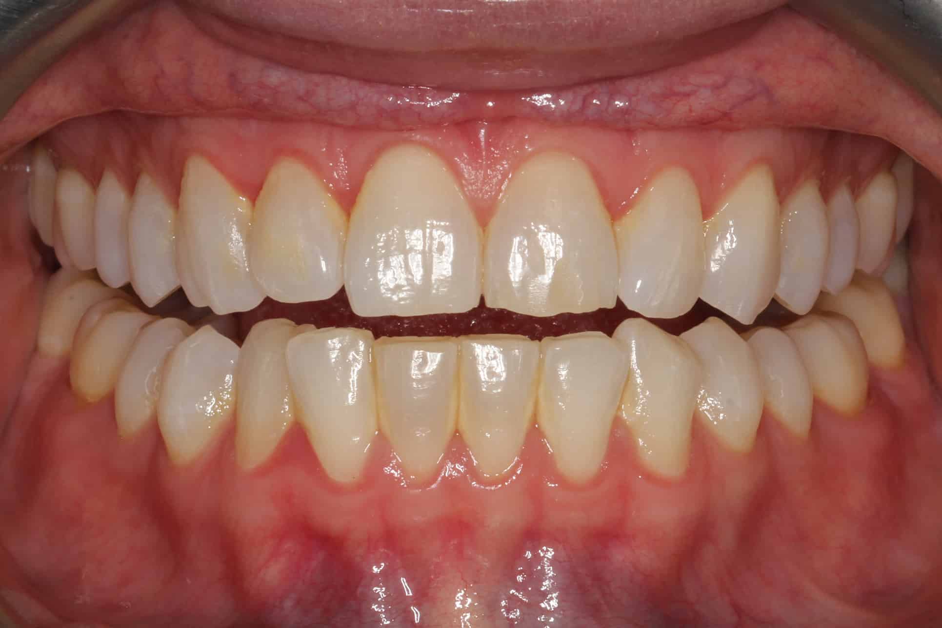 På Kolbotn Tannklinikk dokumenterer tannlegene effekt av tannsteinfjerning – profesjonell tannklinikk i Kolbotn, Oppegård og Nordstrand.