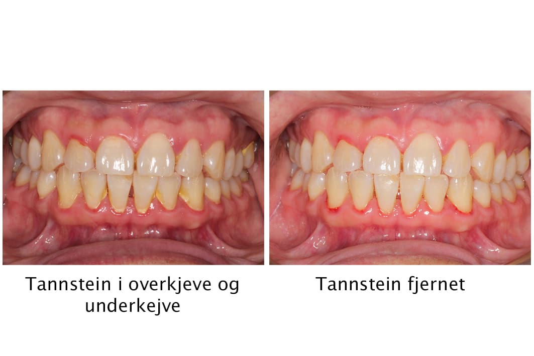Kolbotn Tannklinikk viser galleri av profesjonell fjerning av tannstein – friskere tannkjøtt i Kolbotn, Hauketo og Follo.