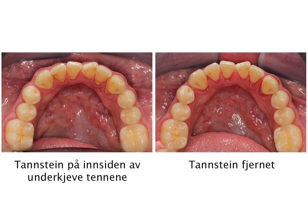 Hos Kolbotn Tannklinikk dokumenteres tannsteinfjerning i galleri – resultat fra behandling i Kolbotn, Oppegård og Nordstrand.