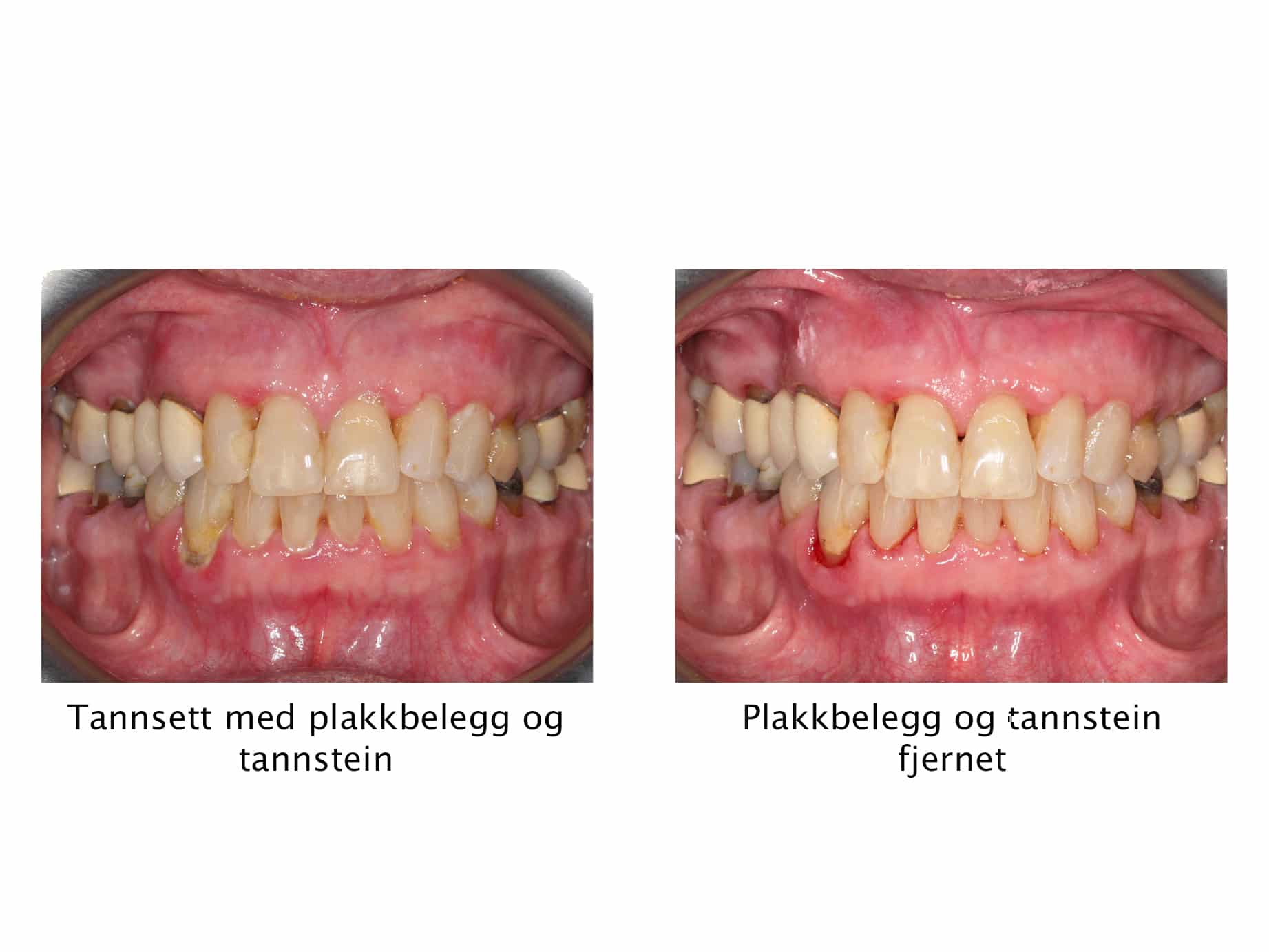 Ved Kolbotn Tannklinikk viser tannlegene resultatet av tannsteinfjerning – utført i Kolbotn, Vinterbro og Holmlia.