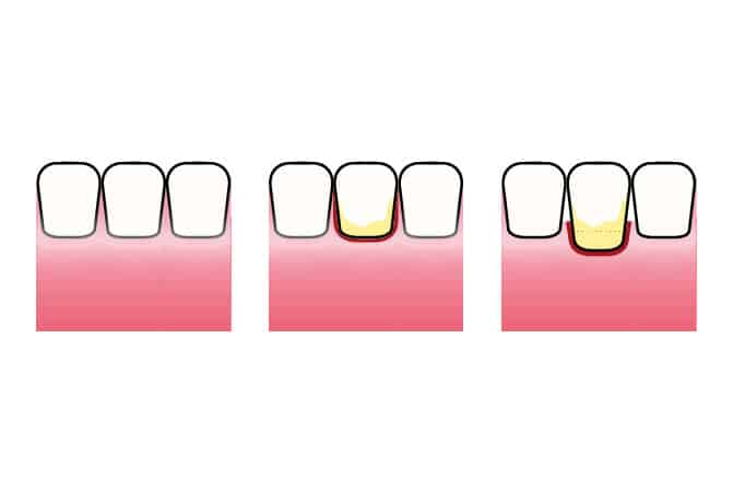 Illustrasjon som viser utviklingen fra friskt tannkjøtt til gingivitt og periodontitt