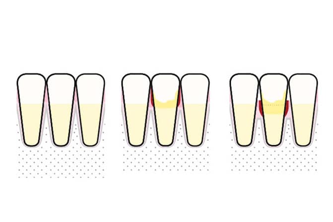 Tannlegene på Kolbotn Tannklinikk forklarer forskjellen mellom gingivitt og periodontitt – moderne tannklinikk i Kolbotn, Vinterbro og Holmlia.