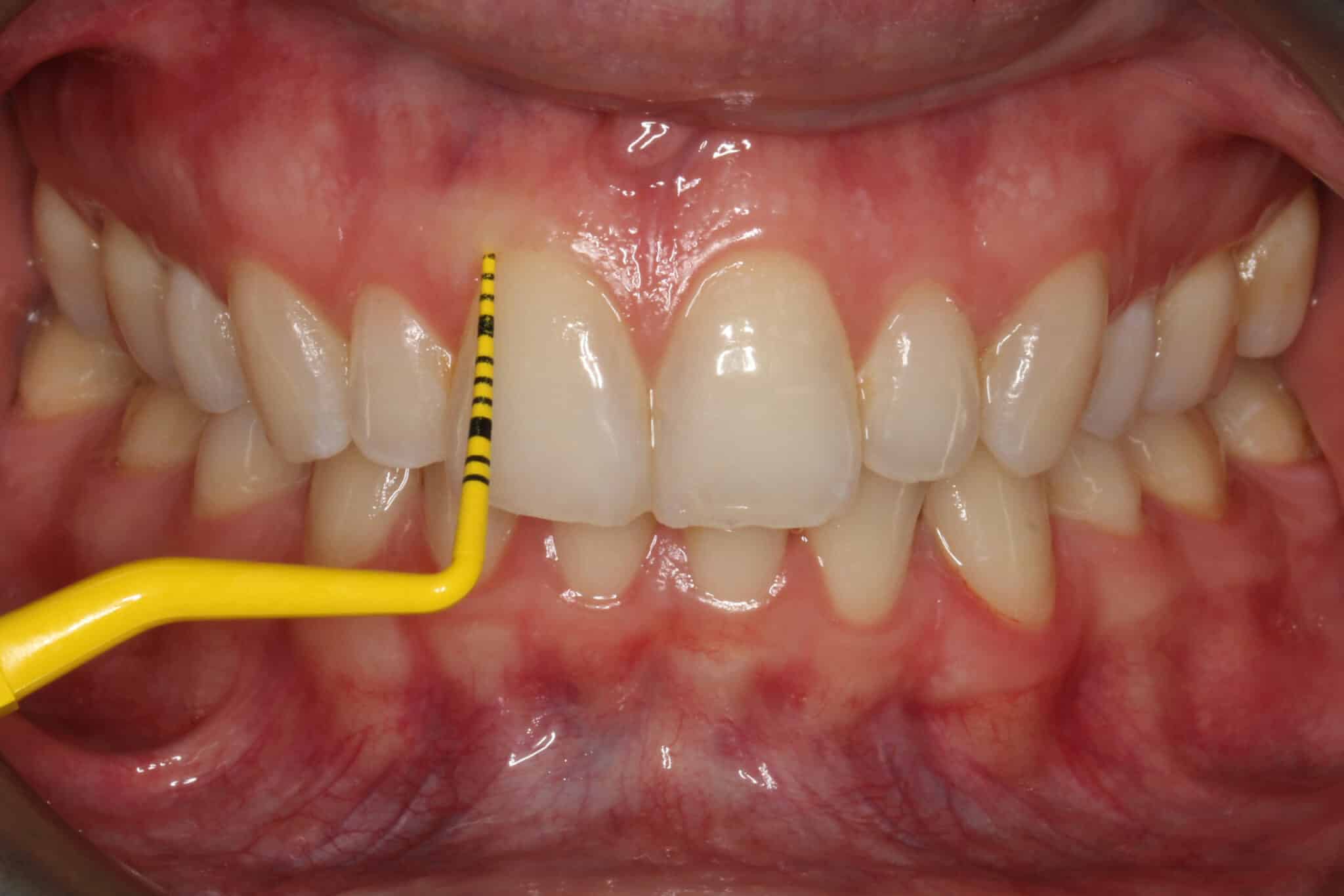 På Kolbotn Tannklinikk bruker tannlegene lommedybdemåler for å oppdage tannkjøttsykdom tidlig – moderne tannklinikk i Kolbotn, Vinterbro og Holmlia.
