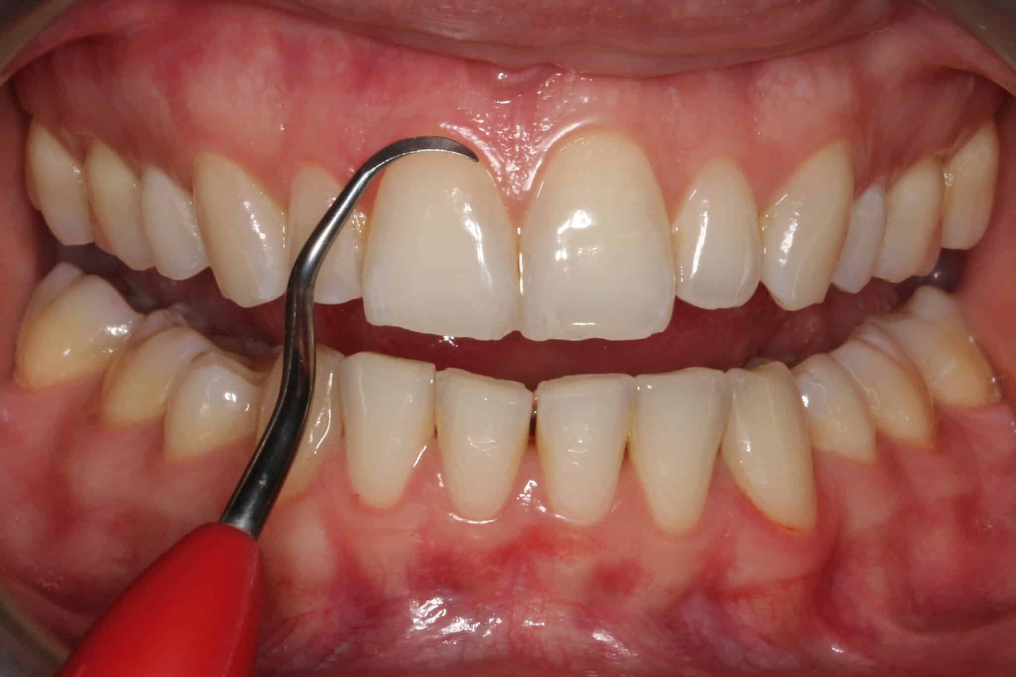 Ved Kolbotn Tannklinikk fjerner tannlegene skjult tannstein under tannkjøttet – avansert behandling i Kolbotn, Follo og Hauketo.