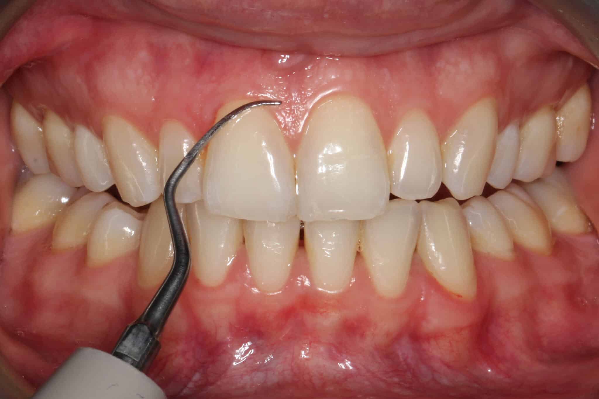 Ved Kolbotn Tannklinikk fjerner tannlegene skjult tannstein under tannkjøttet – avansert behandling i Kolbotn, Follo og Hauketo.