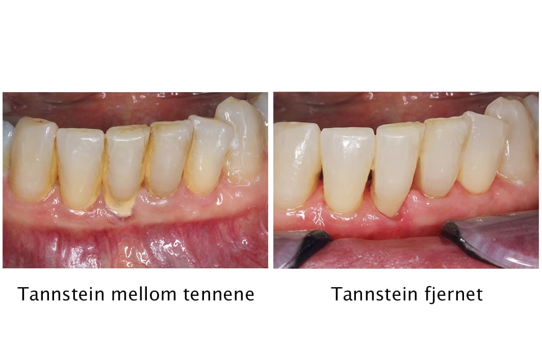 Ved Kolbotn Tannklinikk fjernes tannstein og belegg profesjonelt – sunnere smil i Kolbotn, Myrvoll og Nordstrand.