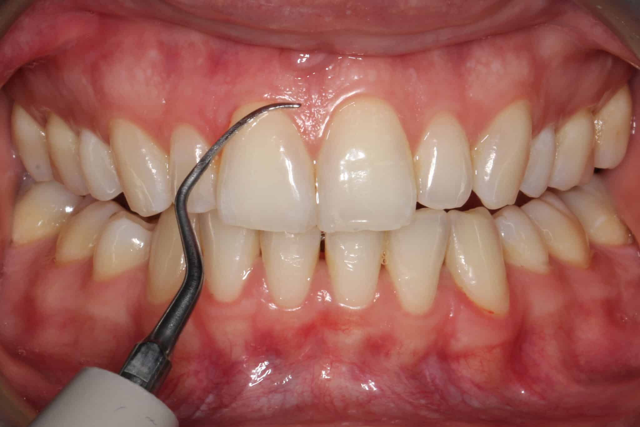 Tannleger på Kolbotn Tannklinikk bruker spesialinstrumenter for å fjerne plakk og tannstein – viktig ledd i behandling av gingivitt i Kolbotn, Oppegård og Myrvoll.