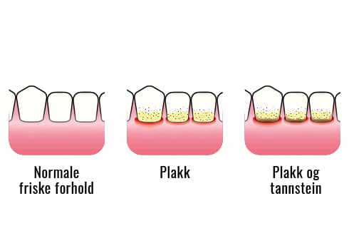 Hos Kolbotn Tannklinikk i Oppegård viser tannlegene forskjellen mellom friskt tannkjøtt og betent tannkjøtt ved gingivitt – pasientinformasjon for Kolbotn, Myrvoll og Nordstrand.