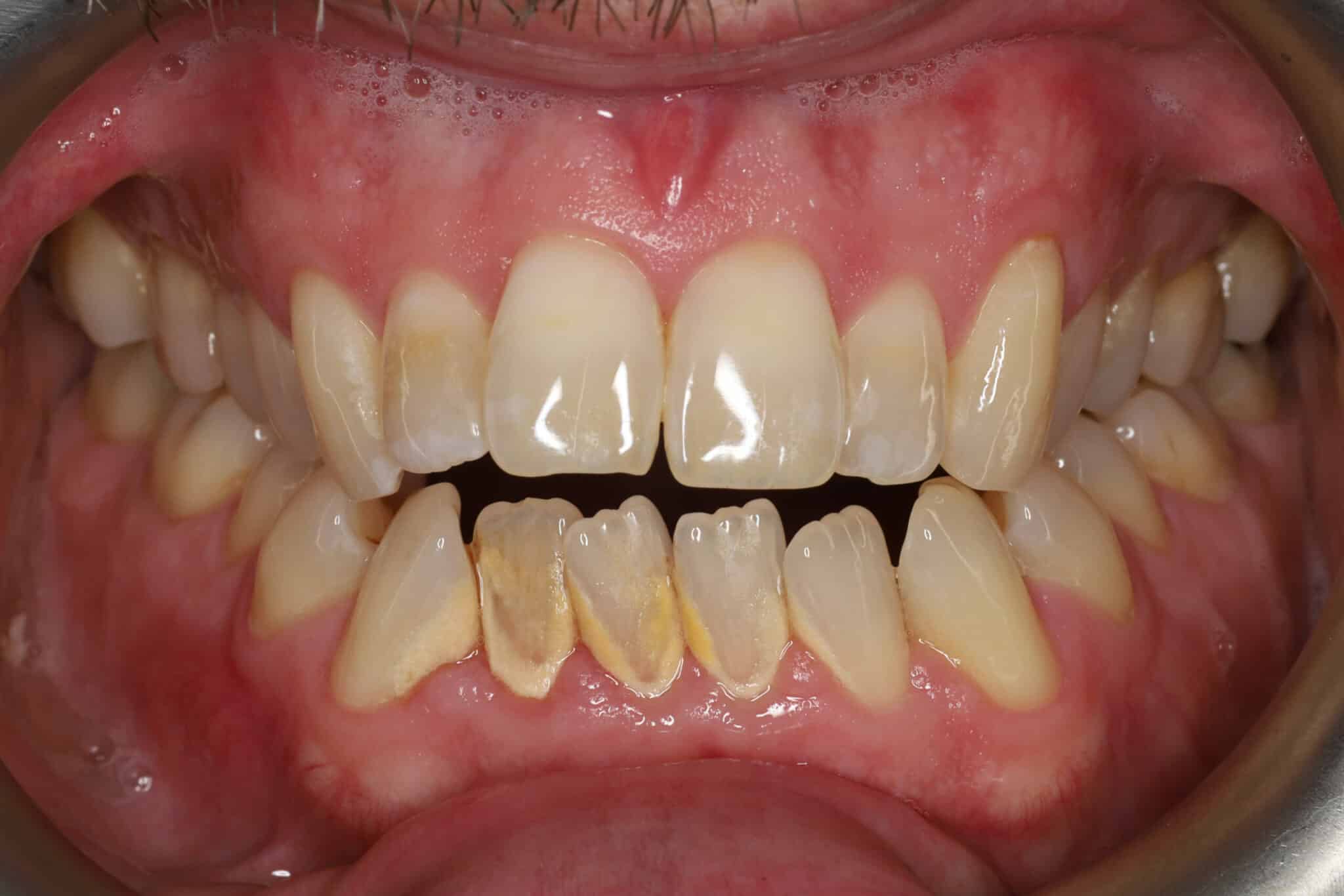 På Kolbotn Tannklinikk behandles betent tannkjøtt med skånsom fjerning av tannstein – friskere tannkjøtt i Kolbotn, Follo og Nordstrand.