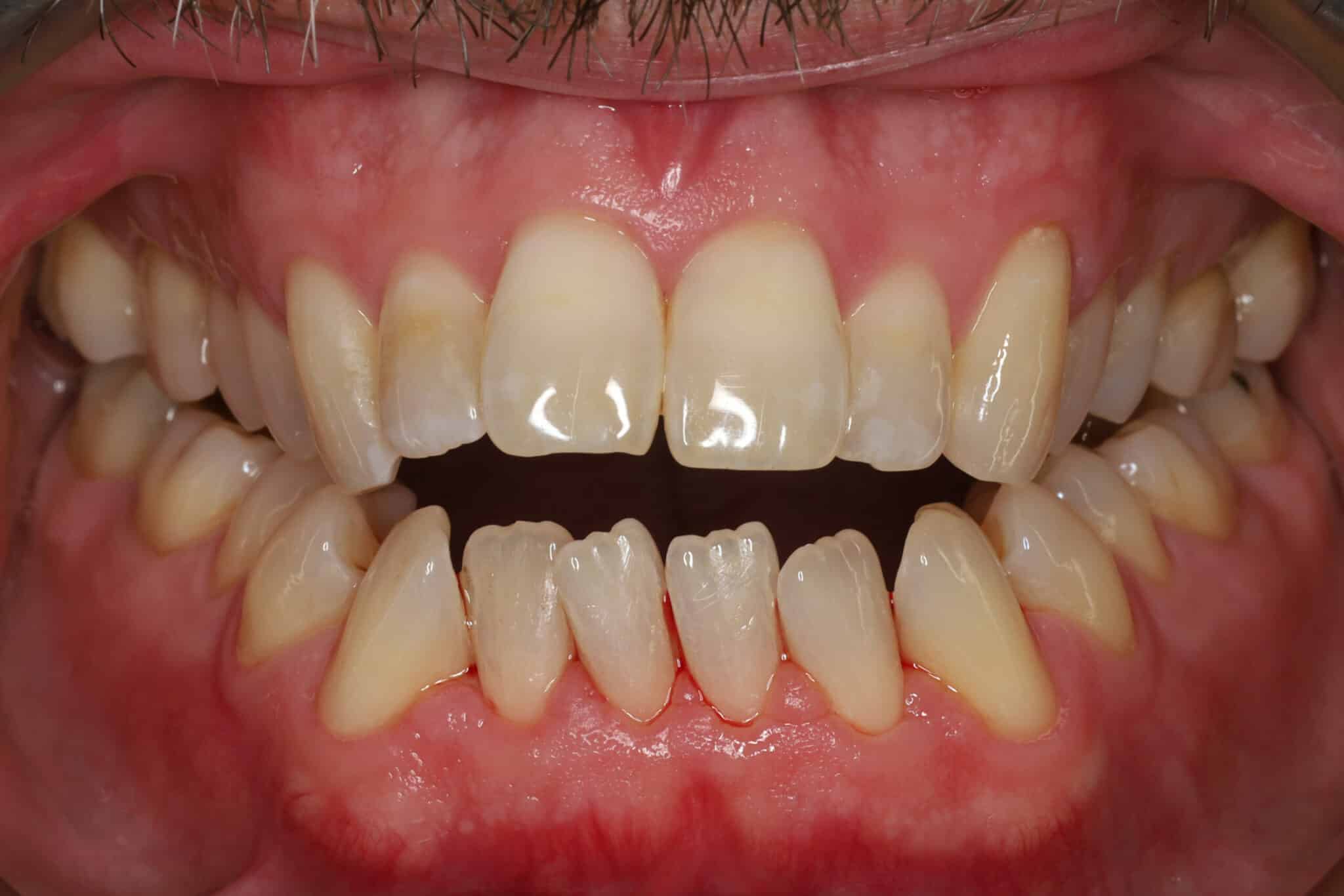 Hos Kolbotn Tannklinikk behandles betent tannkjøtt med skånsom fjerning av tannstein. Bildet viser hvordan gingivitt kan forbedres etter behandling.