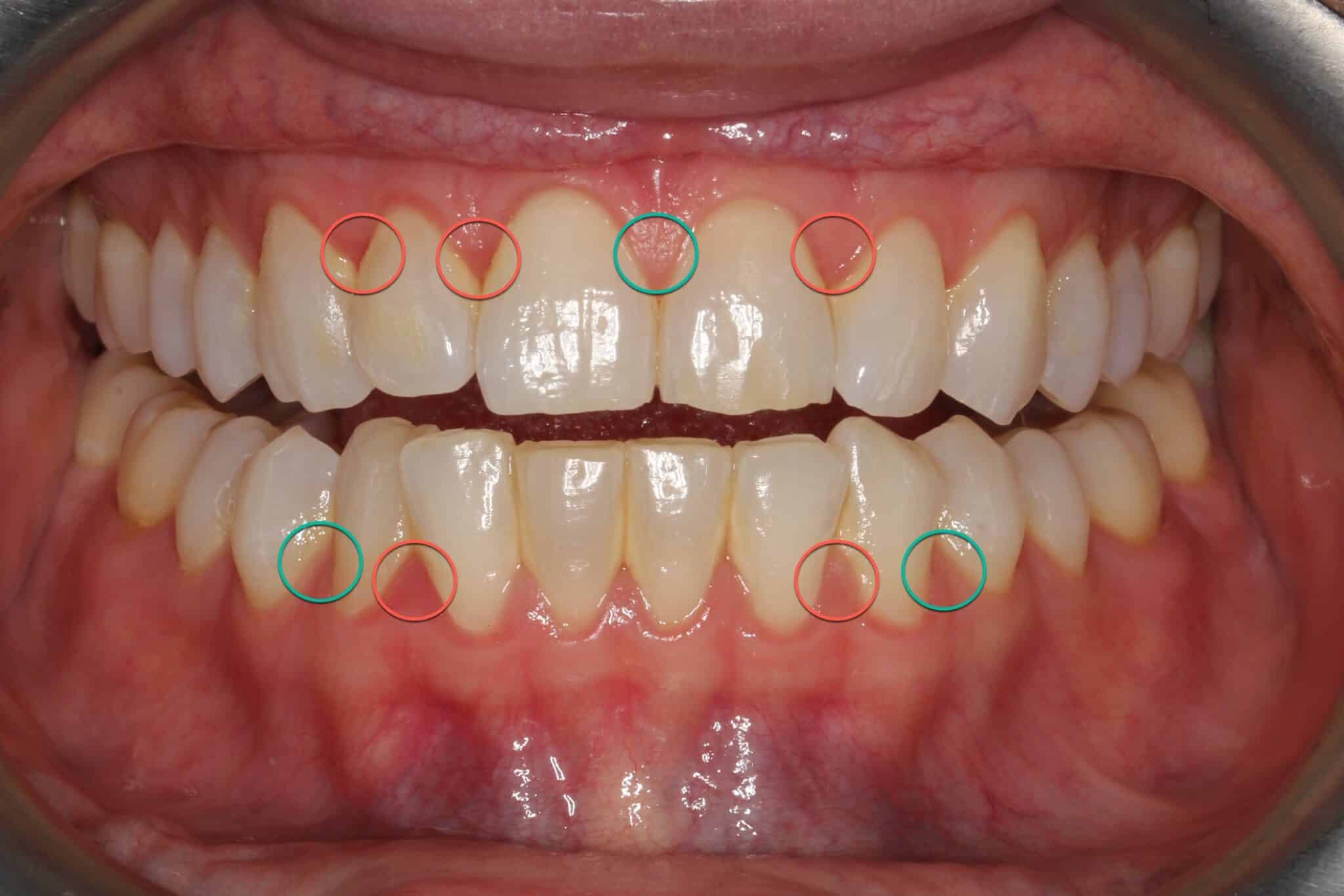 Tannlegene ved Kolbotn Tannklinikk illustrerer tydelig forskjellen mellom friskt tannkjøtt (grønt) og gingivitt (rødt) – pedagogisk forklaring for Kolbotn, Greverud og Holmlia.