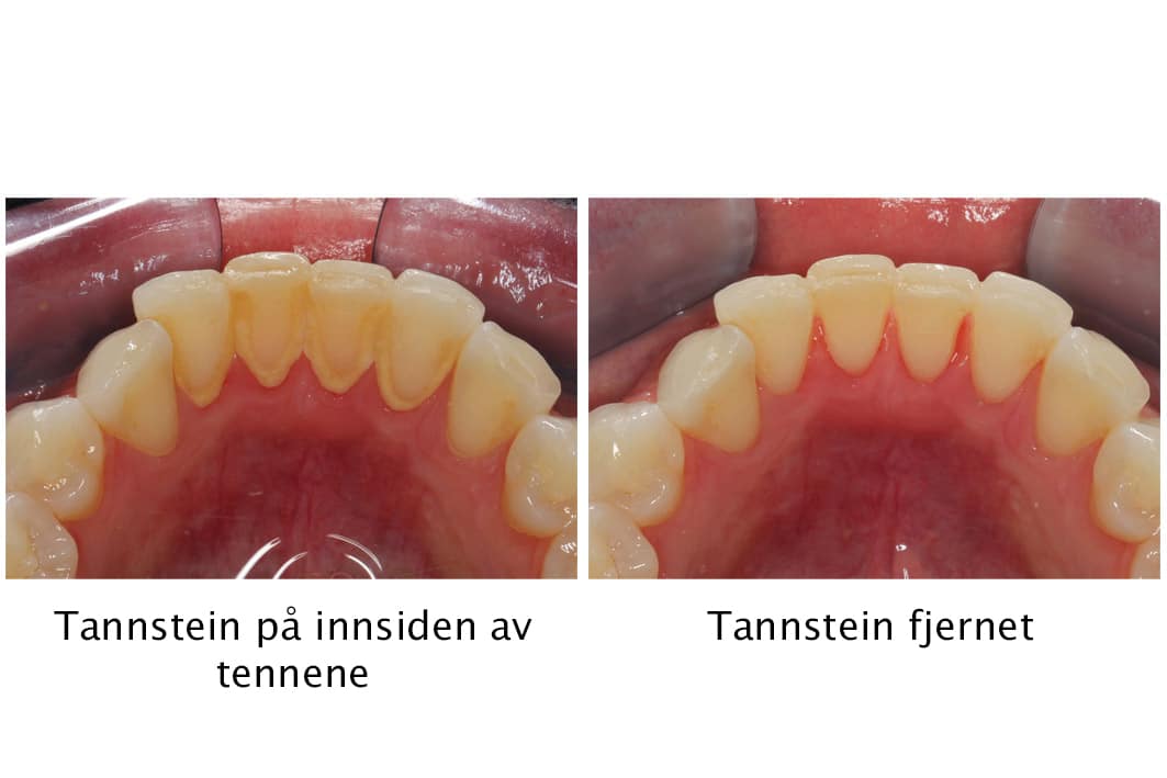 Hos Kolbotn Tannklinikk dokumenteres tannsteinfjerning fra fortenner – sunnere tannkjøtt i Kolbotn, Oppegård og Follo.