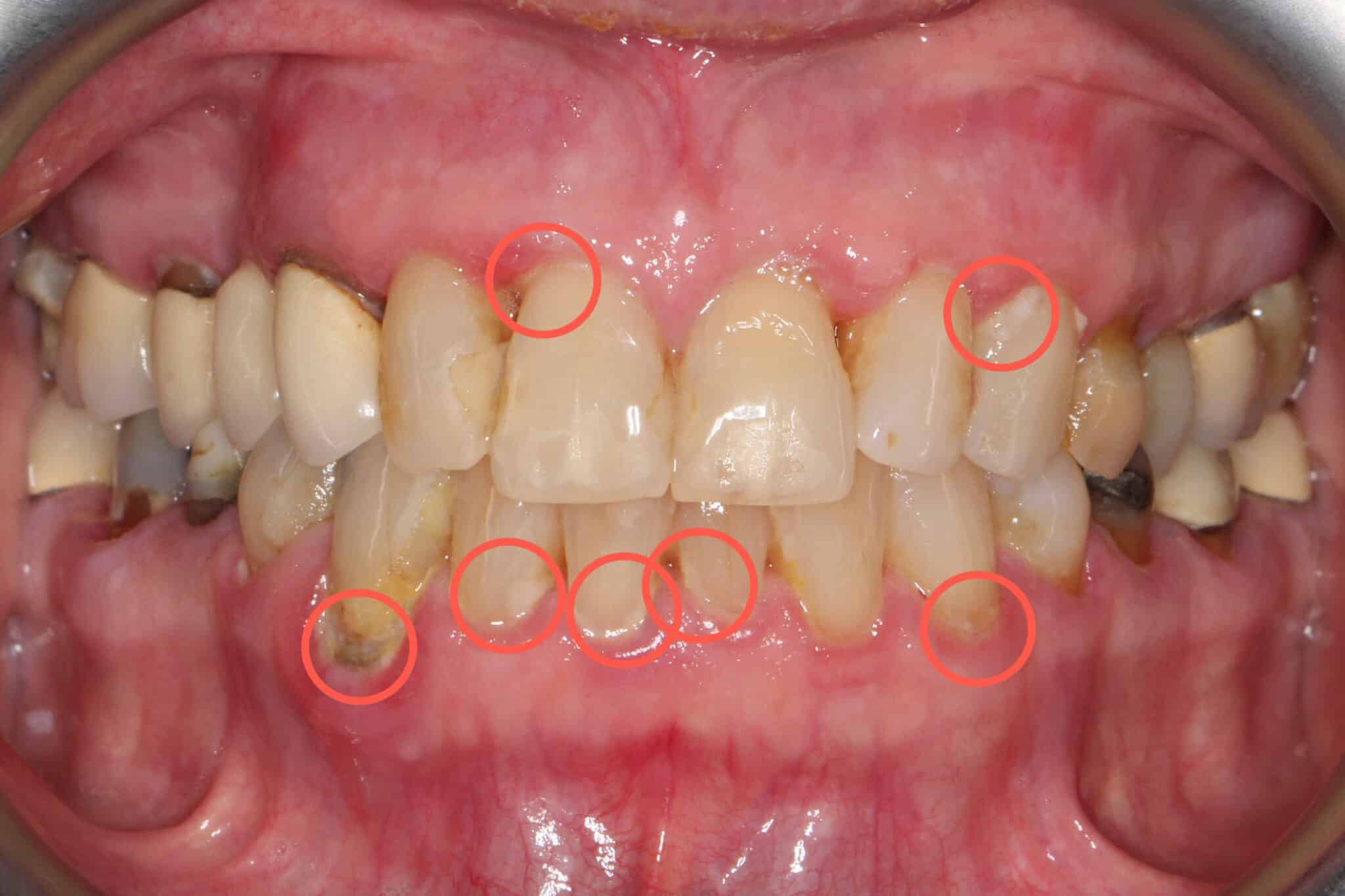 Hos Kolbotn Tannklinikk viser tannlegene hvordan plakk og tannstein fører til periodontitt – pasientinformasjon i Kolbotn, Follo og Oppegård.