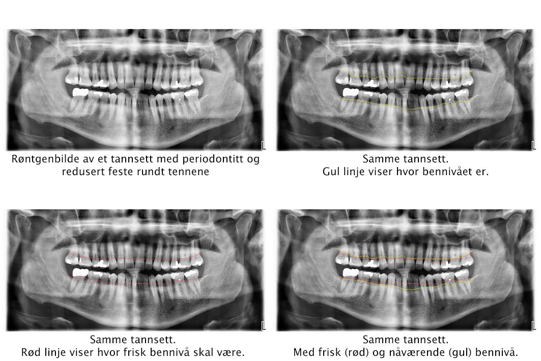 Ved Kolbotn Tannklinikk tas OPG-røntgen for å måle bennivå og oppdage periodontitt – avansert diagnostikk i Kolbotn, Nordstrand og Follo.