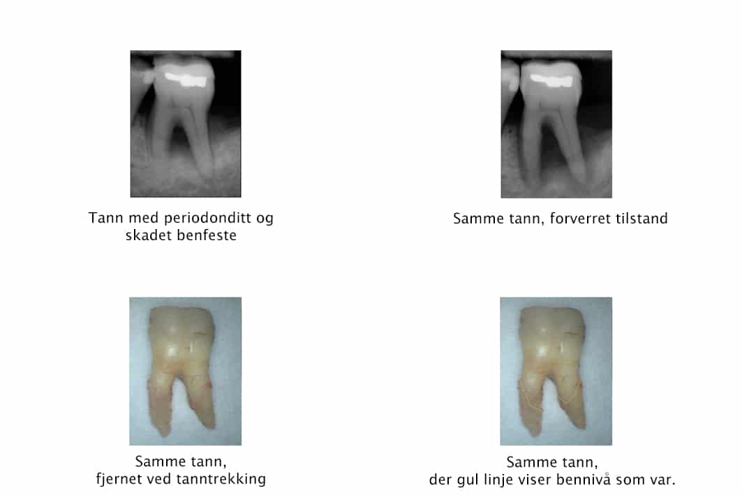 Hos Kolbotn Tannklinikk dokumenteres tanntap som følge av alvorlig periodontitt – behandling i Kolbotn, Holmlia og Vinterbro.