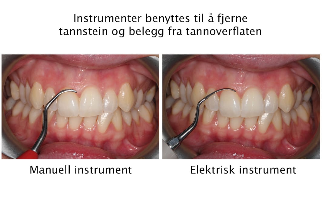 Tannleger ved Kolbotn Tannklinikk benytter scalere for å fjerne tannstein under tannkjøttet – profesjonell behandling i Kolbotn, Oppegård og Follo.