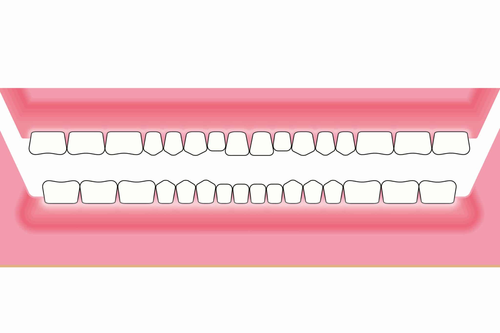 Hos Kolbotn Tannklinikk dokumenteres hvordan periodontitt kan føre til tilbaketrukket tannkjøtt – informasjon til pasienter i Kolbotn, Vinterbro og Nordstrand.