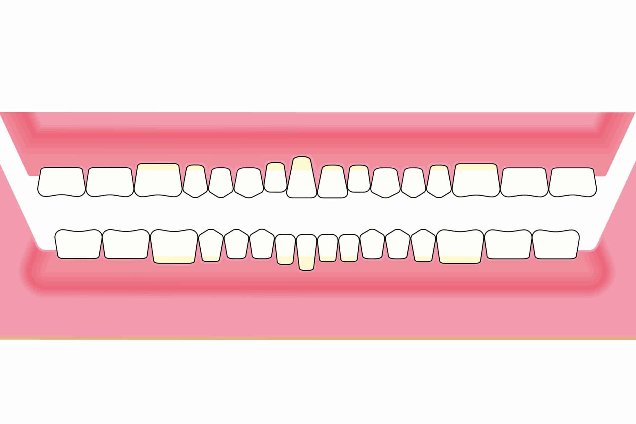 Hos Kolbotn Tannklinikk dokumenteres hvordan periodontitt kan føre til tilbaketrukket tannkjøtt – informasjon til pasienter i Kolbotn, Vinterbro og Nordstrand.