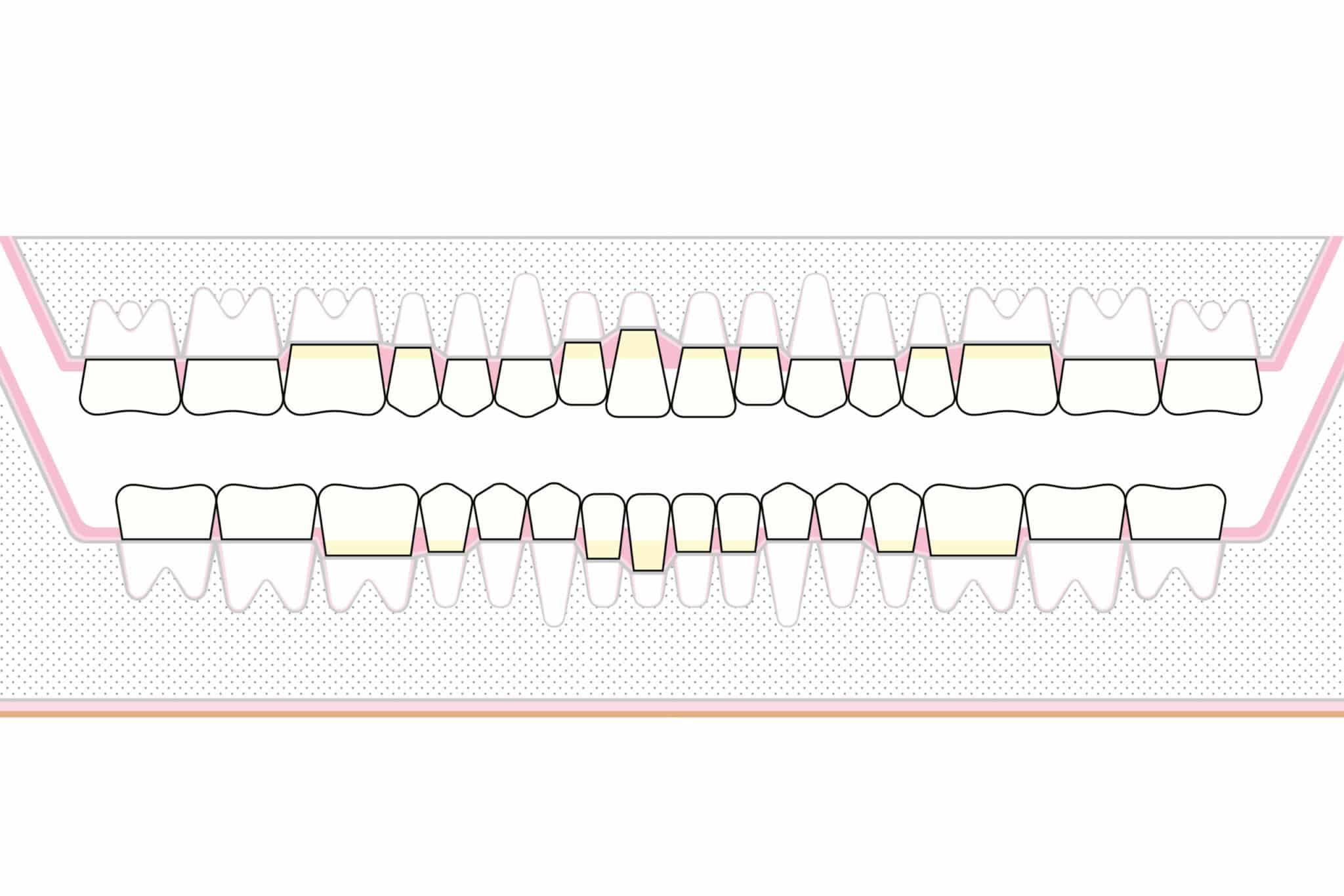 På Kolbotn Tannklinikk vises hvordan periodontitt skader kjevebenet – pasientinformasjon i Kolbotn, Follo og Holmlia.