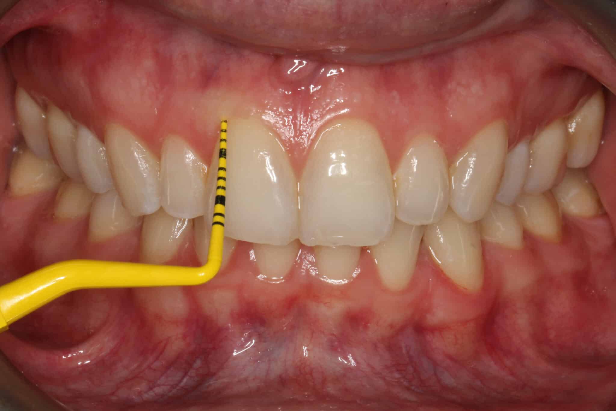 På Kolbotn Tannklinikk bruker tannlegene lommemåler for å oppdage periodontitt tidlig – trygg tannlege i Kolbotn, Vinterbro og Holmlia.