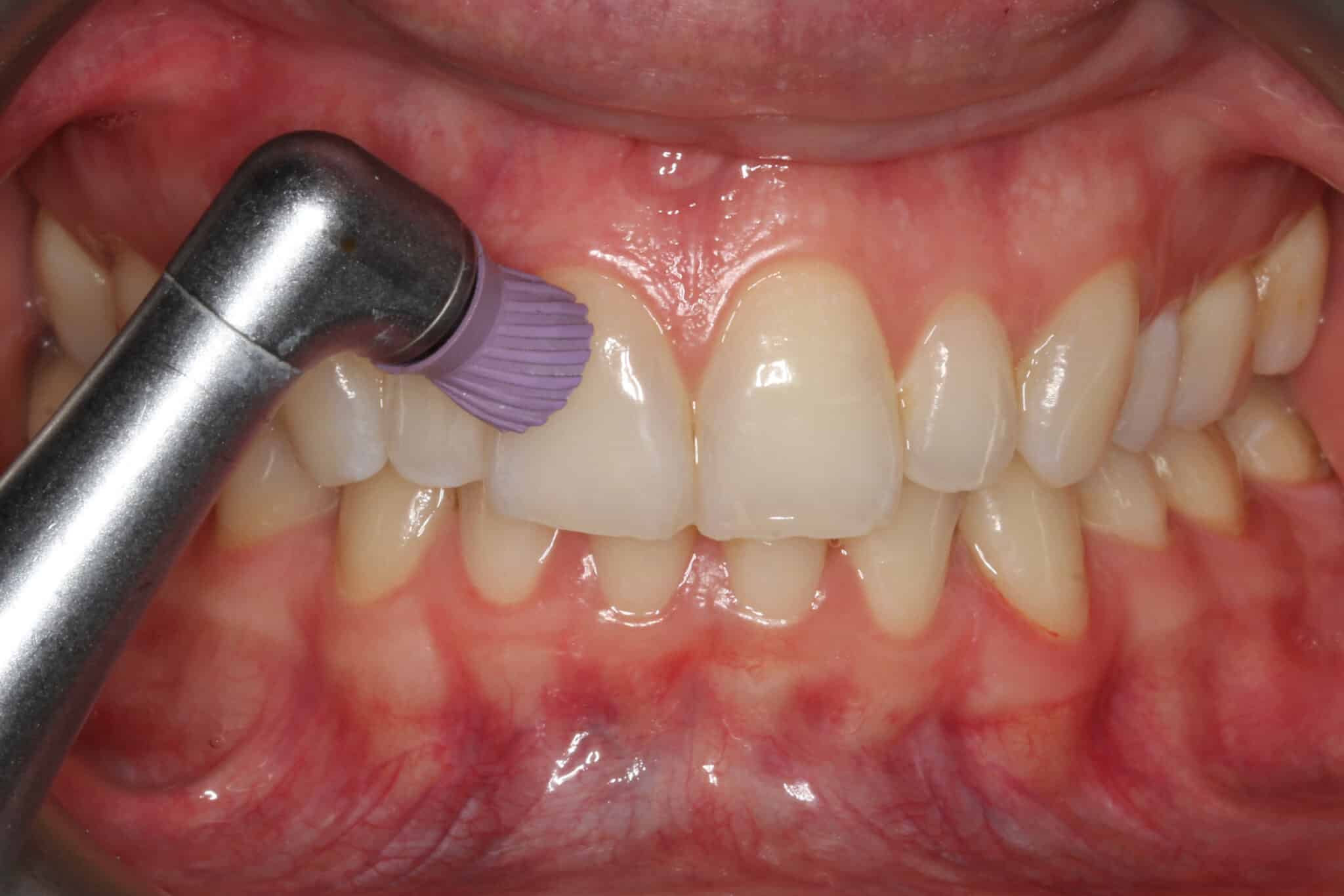 Hos Kolbotn Tannklinikk fjernes plakk og tannstein grundig som del av periodontittbehandling – moderne tannklinikk i Kolbotn, Oppegård og Vinterbro.