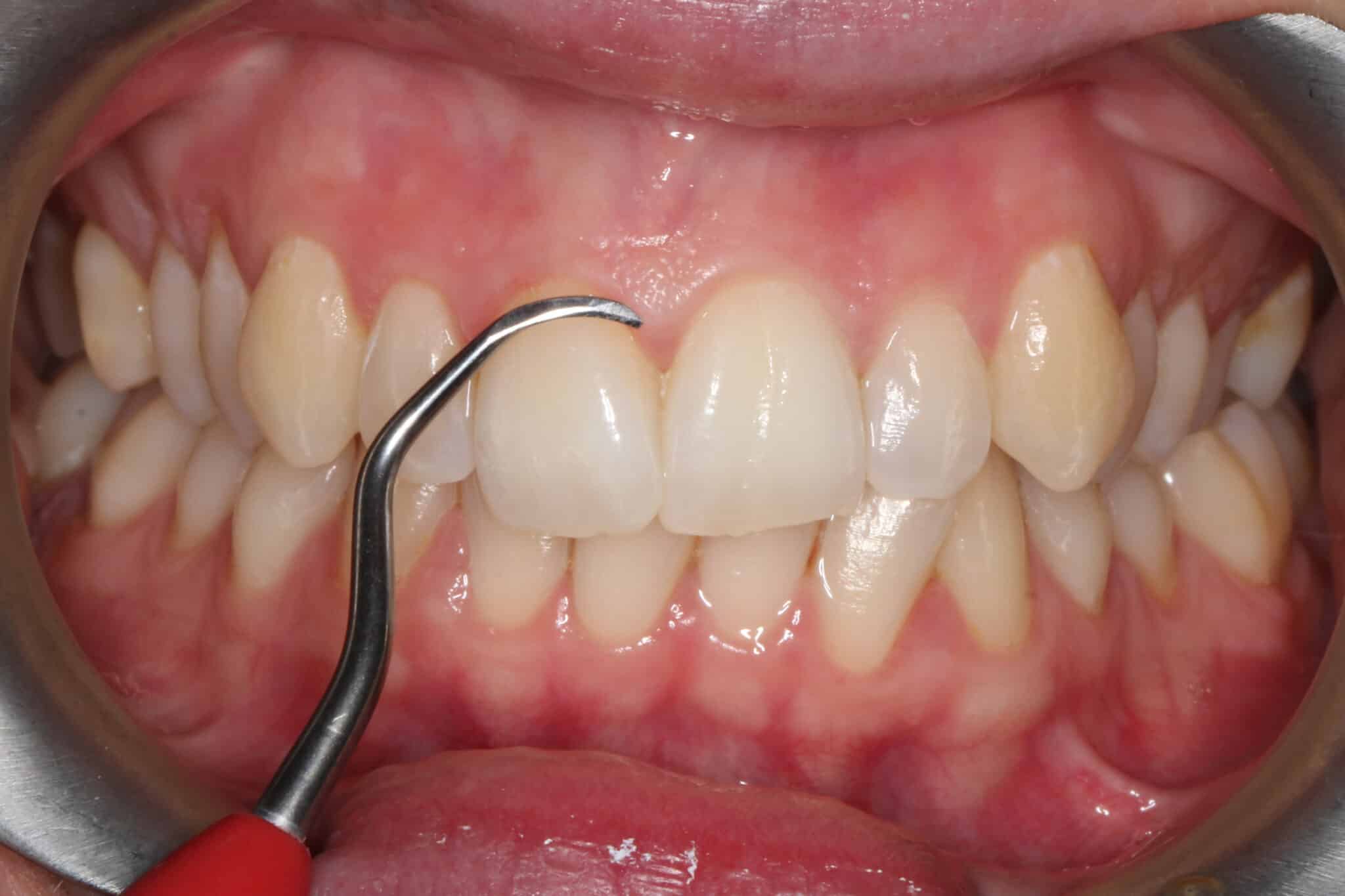 På Kolbotn Tannklinikk benytter tannlegene håndscaler for å rense tennene ved periodontitt – profesjonell behandling i Kolbotn, Follo og Nordstrand.