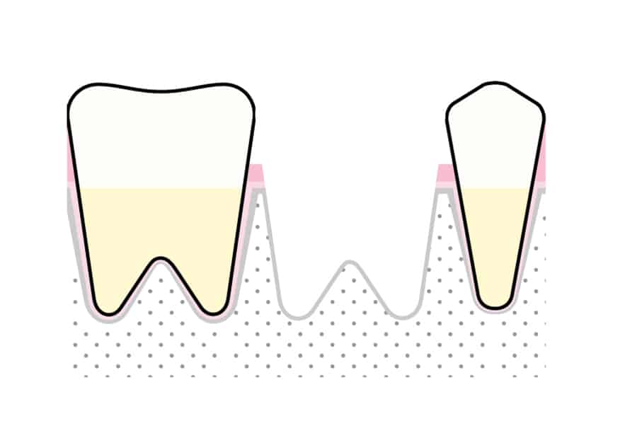 På Kolbotn Tannklinikk viser tannlegene hvordan GTR benyttes for bedre prognose etter tanntrekking – moderne tannklinikk i Kolbotn, Nordstrand og Vinterbro.