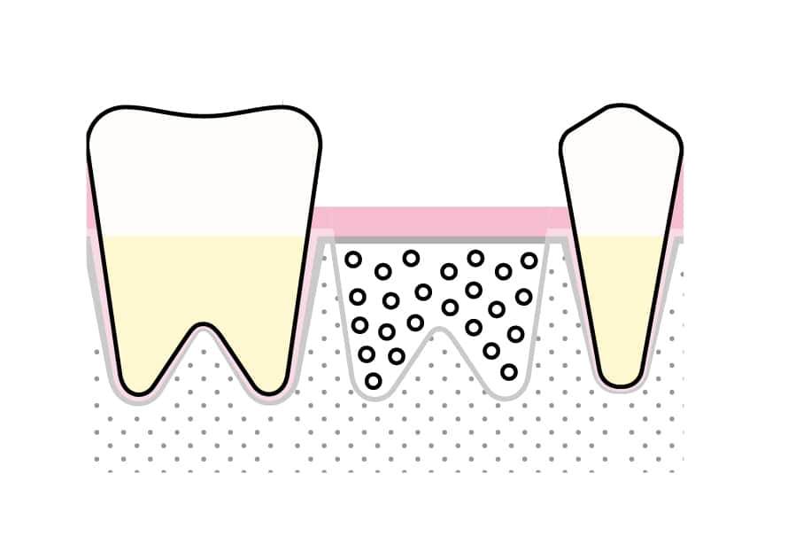 På Kolbotn Tannklinikk viser tannlegene hvordan GTR benyttes for bedre prognose etter tanntrekking – moderne tannklinikk i Kolbotn, Nordstrand og Vinterbro.