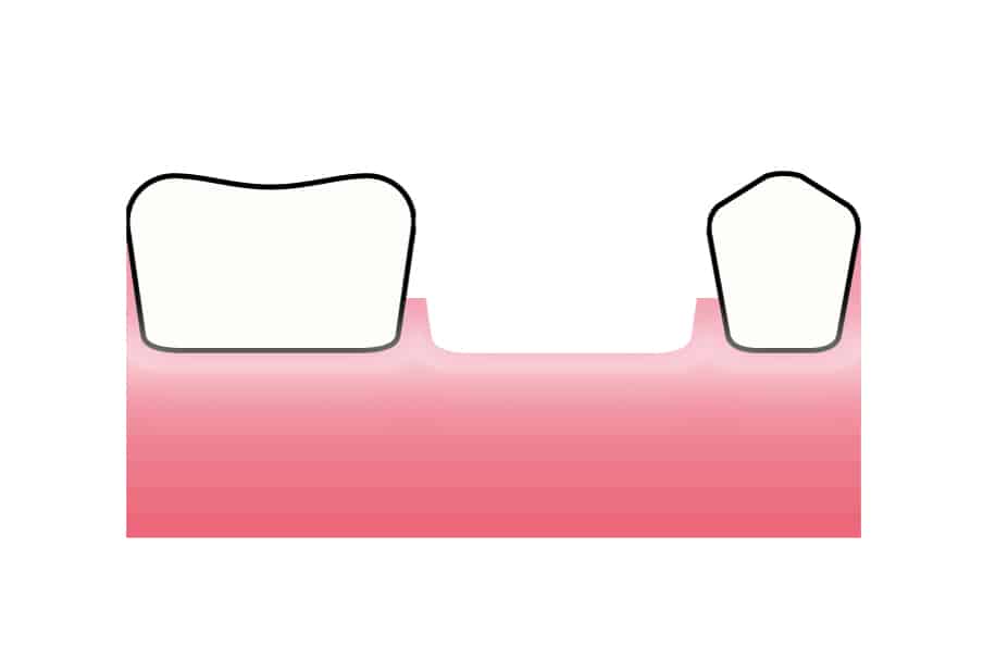 Ved Kolbotn Tannklinikk illustrerer tannlegene forskjellen på tilheling med og uten GTR – trygg behandling for pasienter i Kolbotn, Oppegård, Follo og Holmlia.