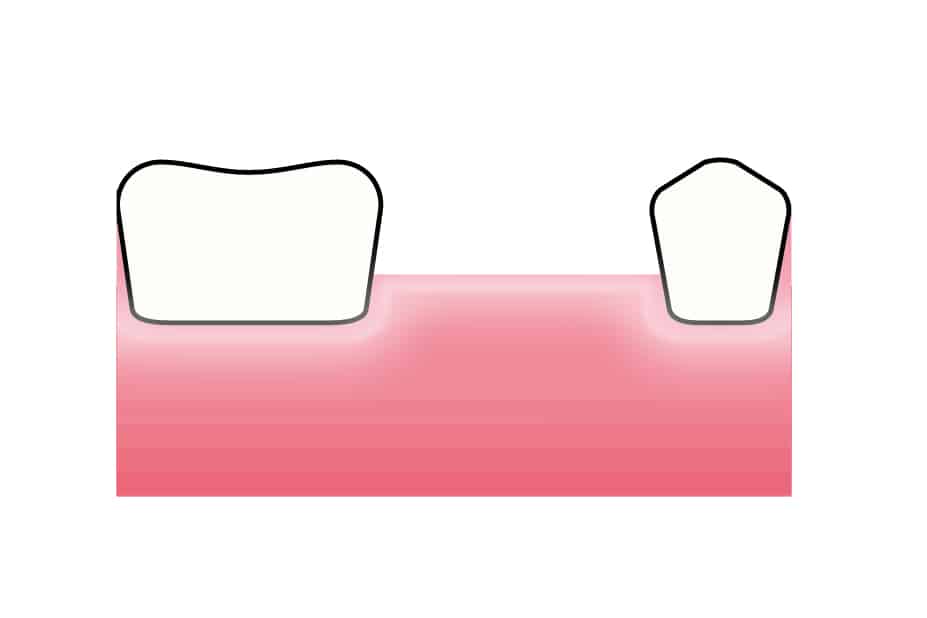 Ved Kolbotn Tannklinikk illustrerer tannlegene forskjellen på tilheling med og uten GTR – trygg behandling for pasienter i Kolbotn, Oppegård, Follo og Holmlia.