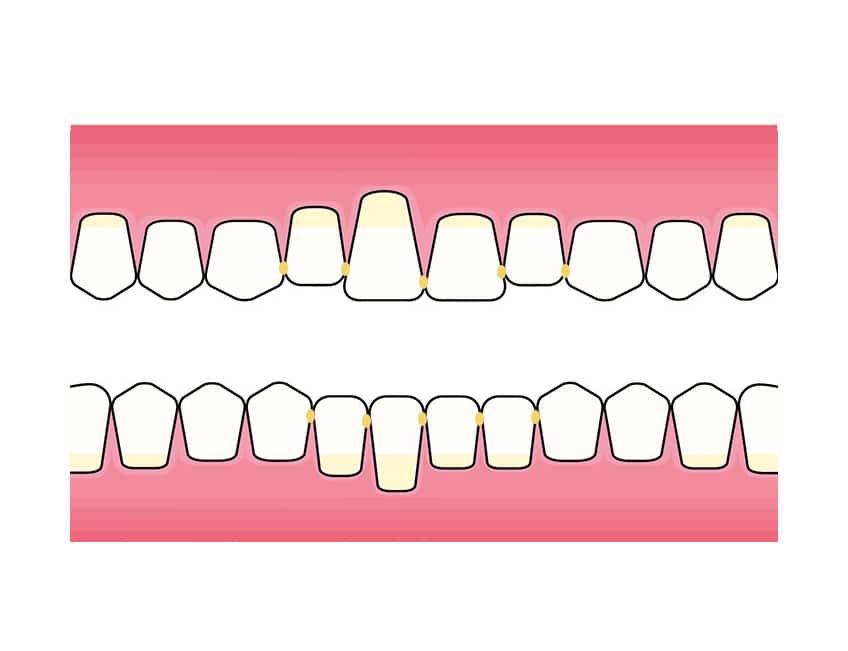 Hos Kolbotn Tannklinikk brukes lim (Superbond) til splinting av tenner – moderne tannklinikk i Kolbotn, Oppegård, Holmlia og Myrvoll.