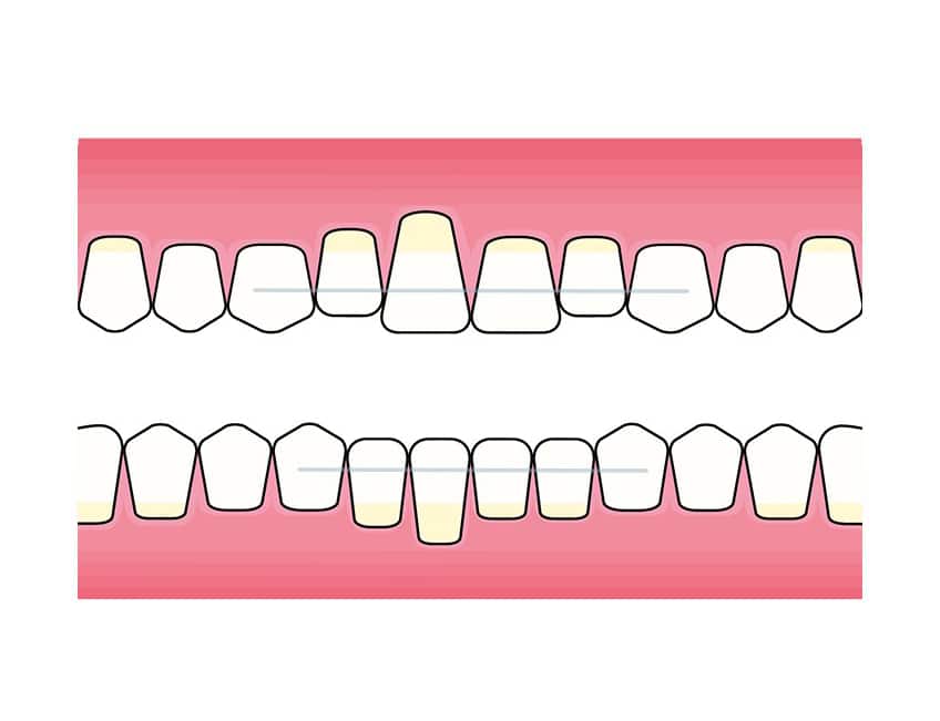 Hos Kolbotn Tannklinikk stabiliserer tannlegene løse tenner med metalltråd – trygg behandling i Kolbotn, Follo, Nordstrand og Holmlia.