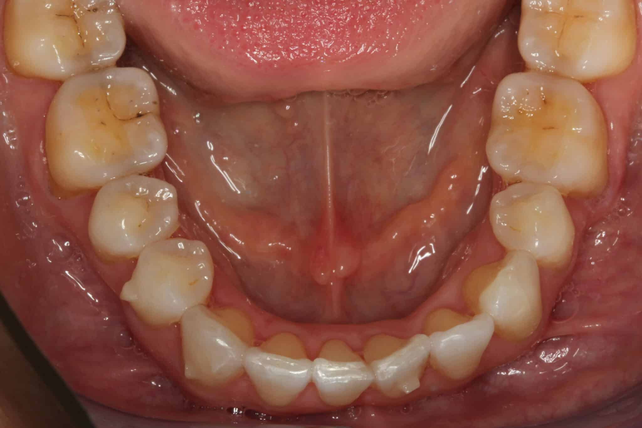 Før- og etterbilde: Splinting med metalltråd ved Kolbotn Tannklinikk – løse tenner stabilisert i Kolbotn, Vinterbro og Follo.