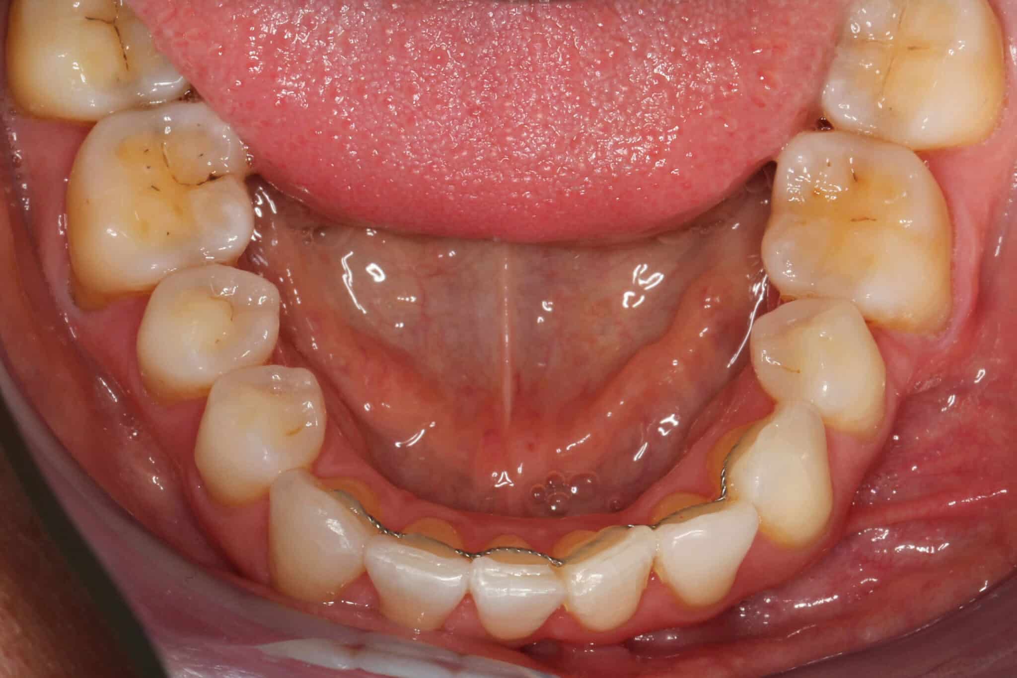 Ved Kolbotn Tannklinikk brukes metallbøyle som splinting etter tannregulering – pasienter i Kolbotn, Oppegård, Vinterbro og Myrvoll.
