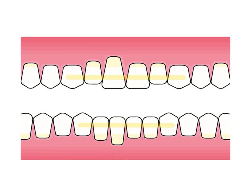 På Kolbotn Tannklinikk benytter tannleger fibertråd (Everstick) som diskret splinting – behandling i Kolbotn, Follo, Greverud og Holmlia.