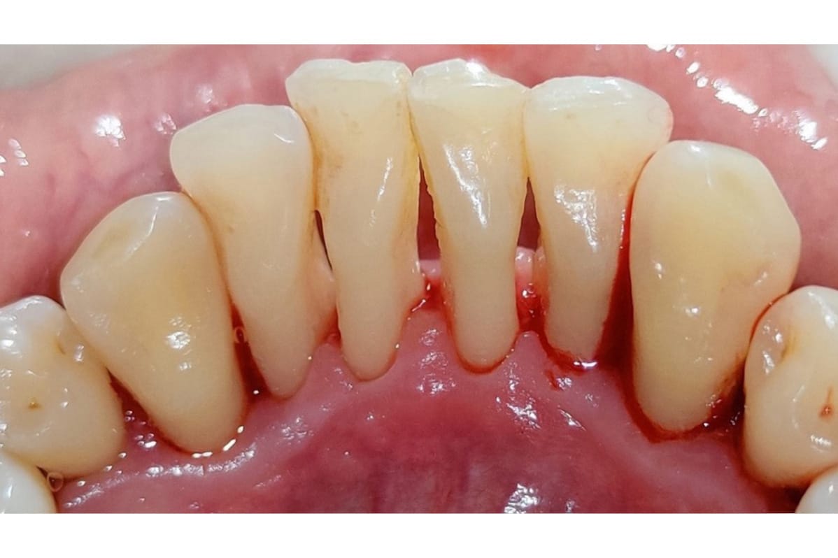 Før- og etterbilde: Fibertråd-splinting (Everstick) ved Kolbotn Tannklinikk – stabilisering i Kolbotn, Holmlia og Nordstrand.