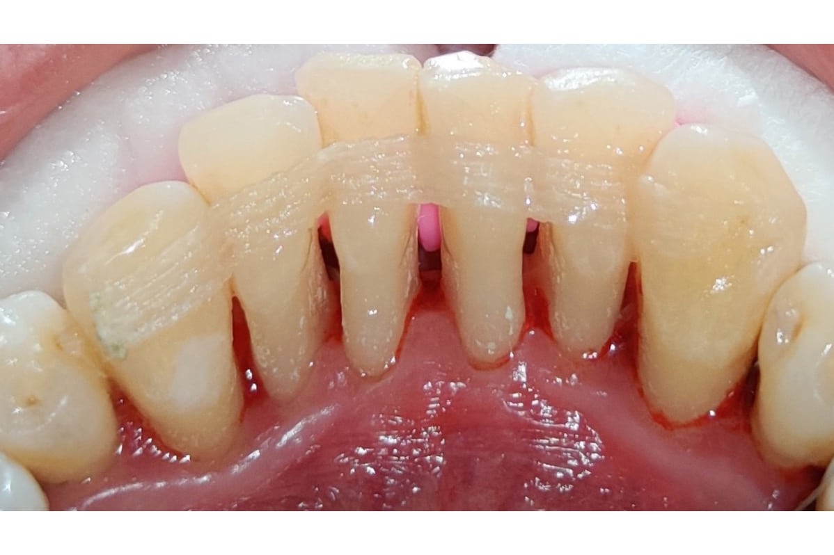 Før- og etterbilde: Fibertråd-splinting (Everstick) ved Kolbotn Tannklinikk – stabilisering i Kolbotn, Holmlia og Nordstrand.