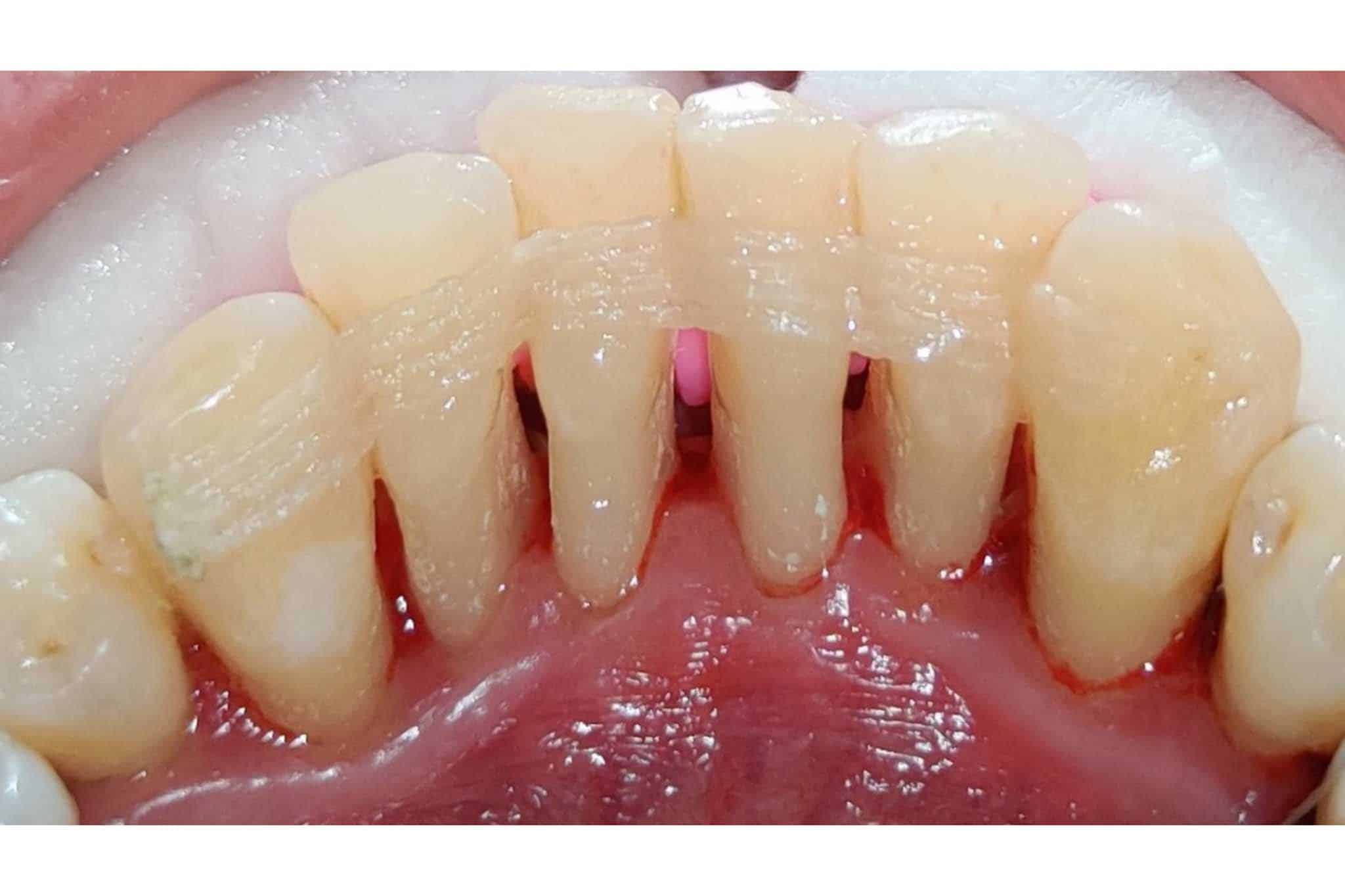 Før- og etterbilder: Hos Kolbotn Tannklinikk stabiliseres løse tenner med Everstick-splint – akutt behandling i Kolbotn, Greverud, Myrvoll og Follo.