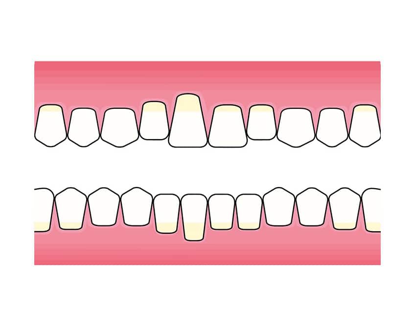 Superbond-lim brukt til å feste tenner sammen.