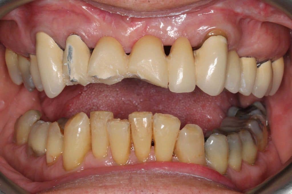 Hos Kolbotn Tannklinikk behandler tannleger tannskader etter ulykker og traumer – trygg tannlegevakt i Kolbotn, Follo, Oppegård og Vinterbro.