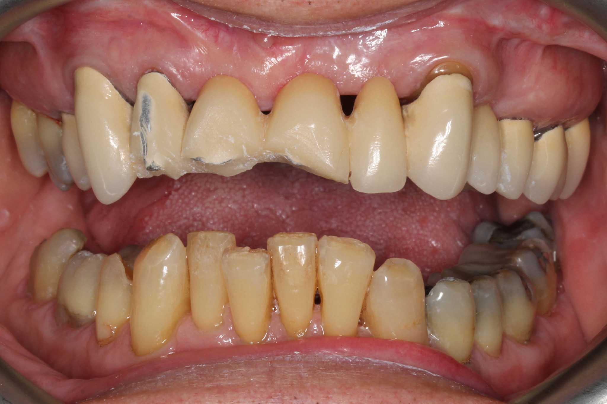 Hos Kolbotn Tannklinikk behandler tannleger tannskader etter ulykker og traumer – trygg tannlegevakt i Kolbotn, Follo, Oppegård og Vinterbro.