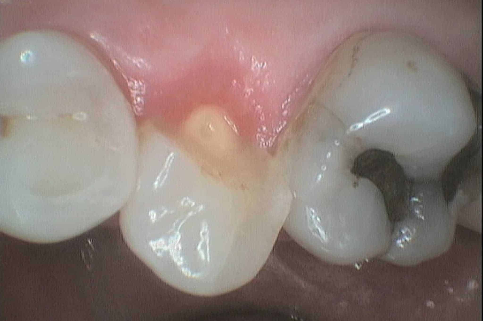 Hos Kolbotn Tannklinikk behandles frakturerte og knekte tenner raskt på tannlegevakten – Kolbotn, Holmlia, Vinterbro og Follo.