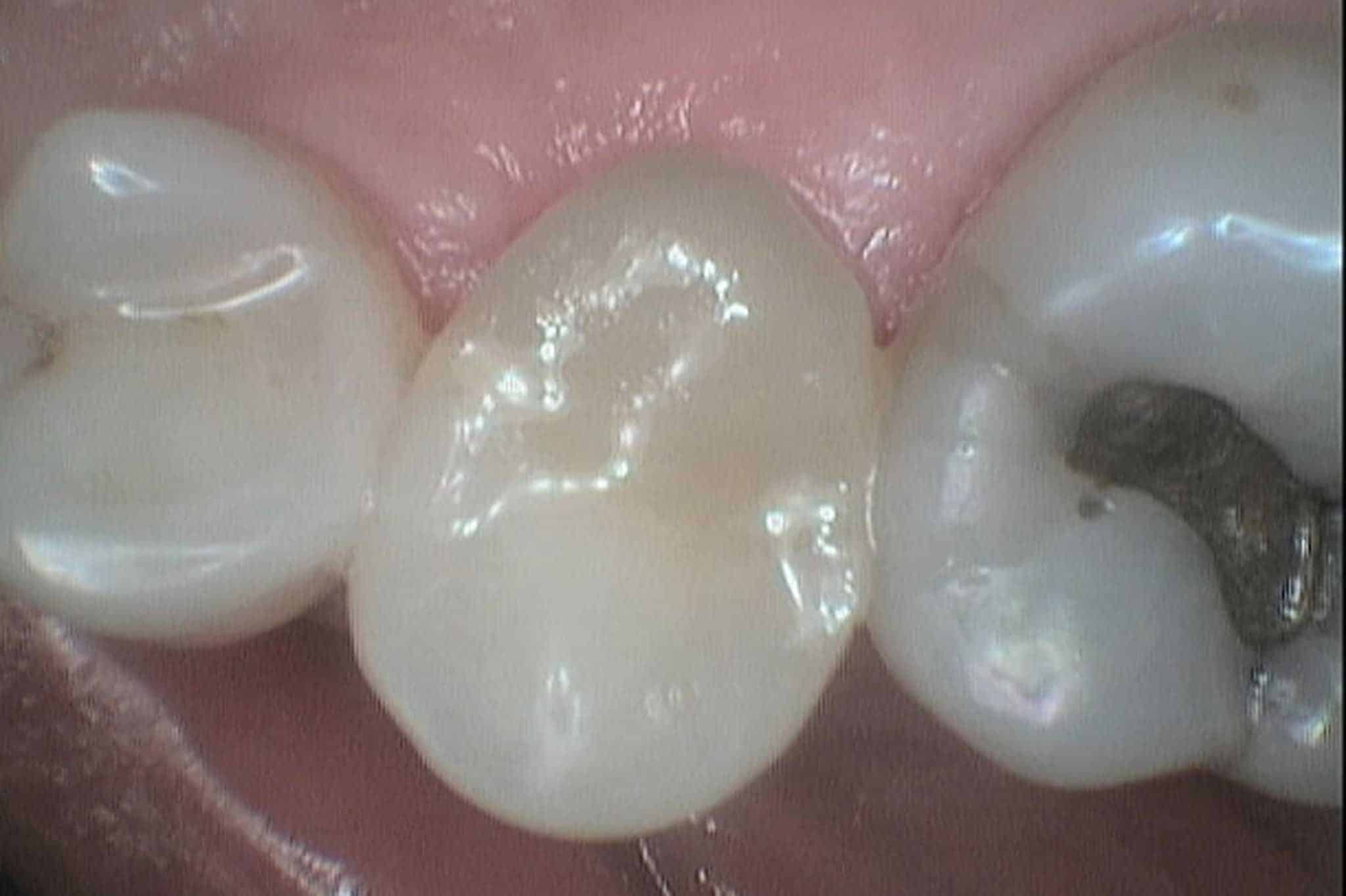 Ved Kolbotn Tannklinikk viser vi før- og etterbilder av frakturert tann oppbygget med krone – moderne tannlegevakt i Kolbotn, Vinterbro og Follo.