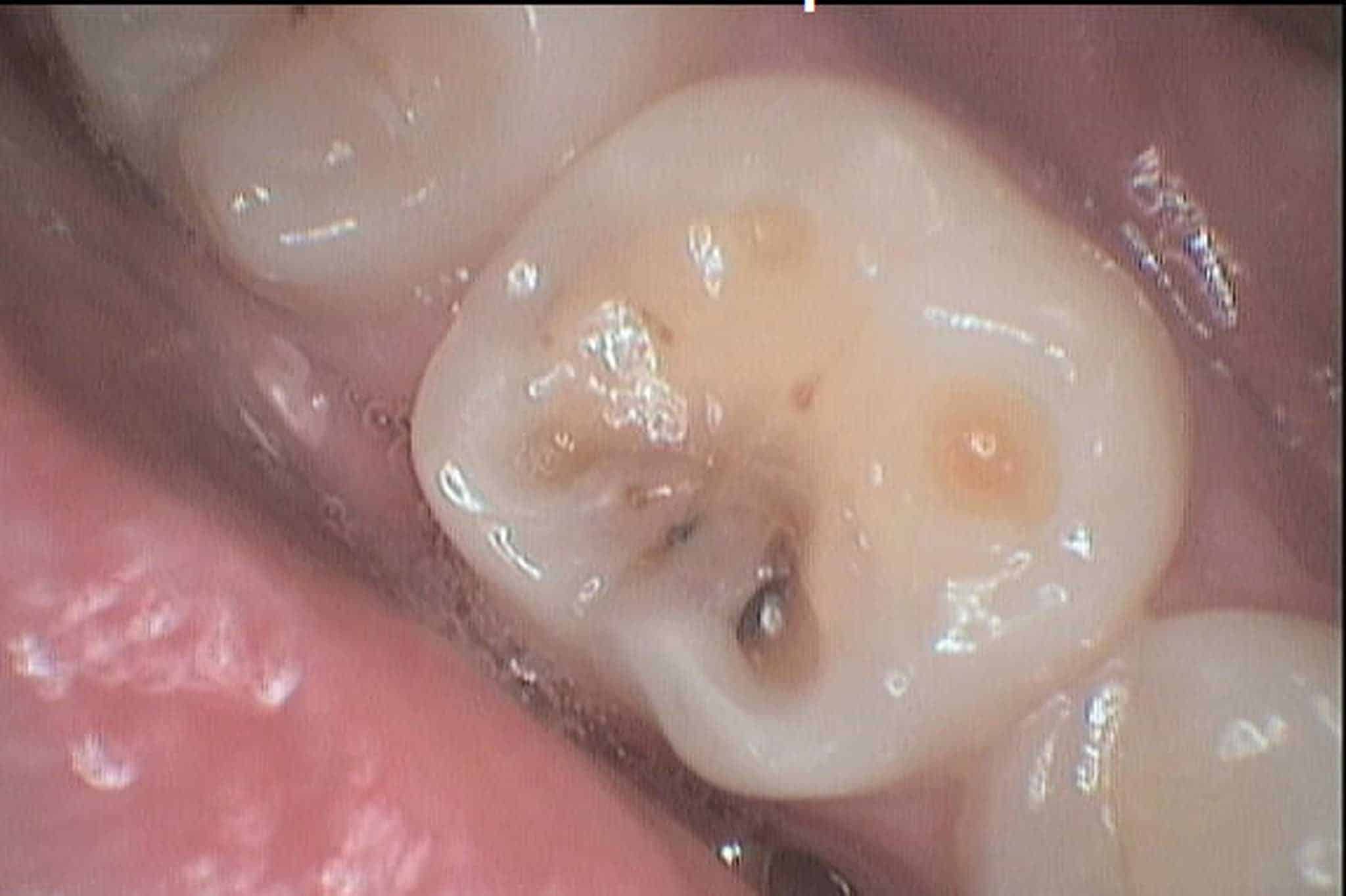 Hos Kolbotn Tannklinikk behandler tannlegevakten hull i tennene med akutt tannverk – Kolbotn, Myrvoll, Sofiemyr og Follo.